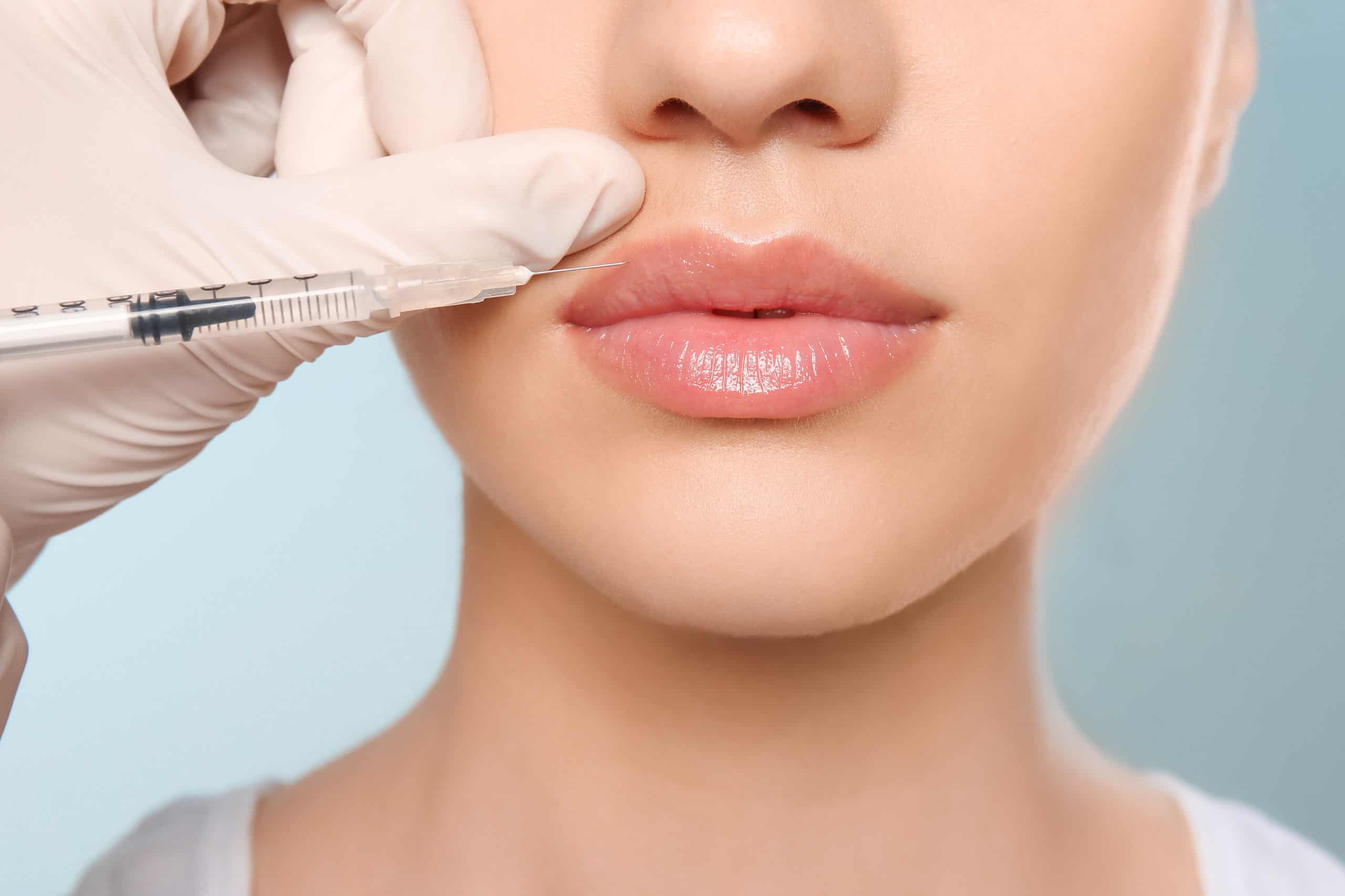 10 Points To Know Before Getting Lip Fillers